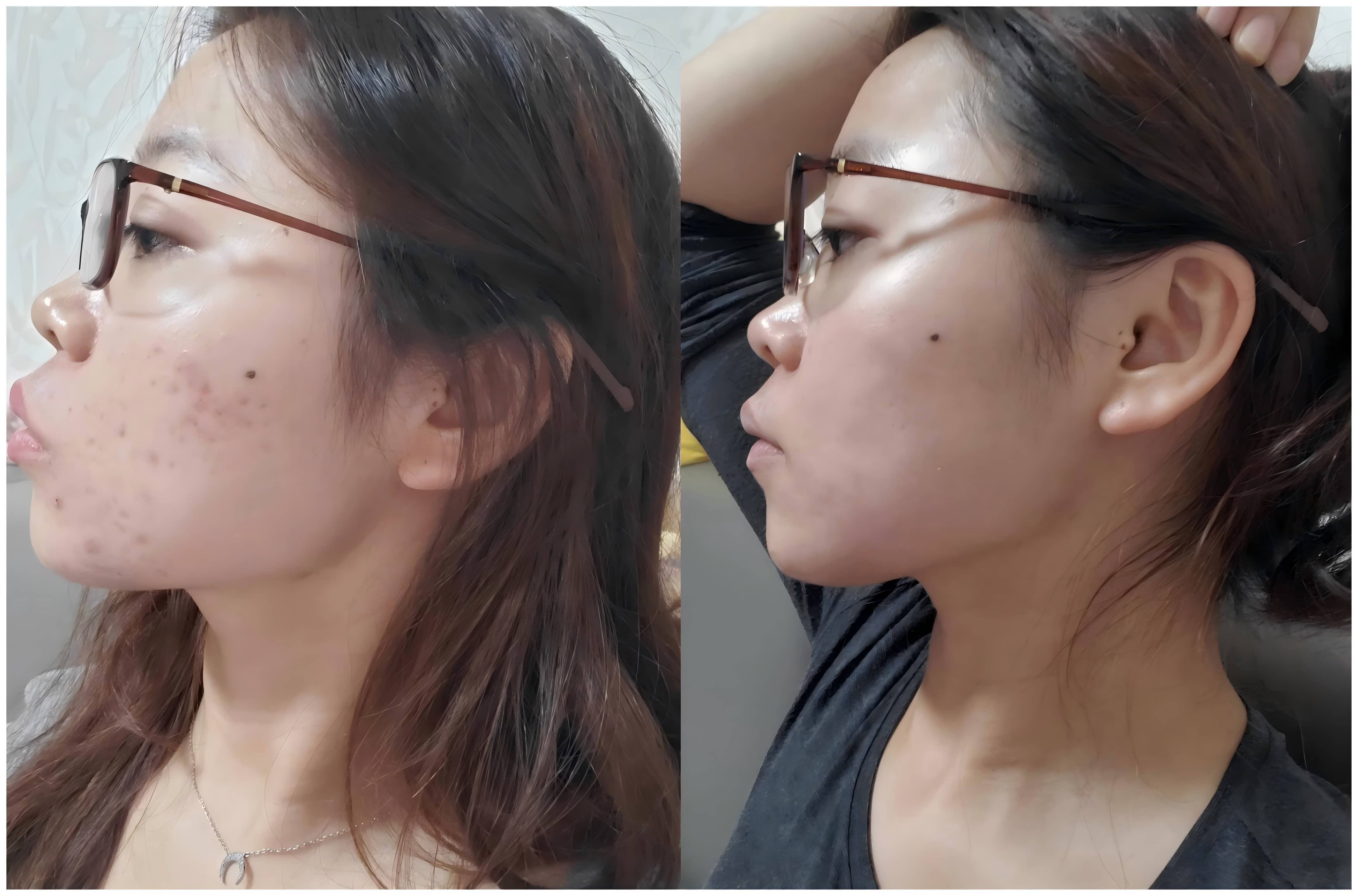 Before and after results of using disposable facial towels on acne-prone skin – visible reduction in redness and breakouts after use