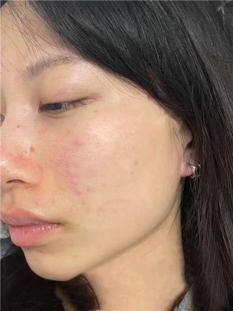 Yuki’s irritated skin with redness and small bumps before using facial towels