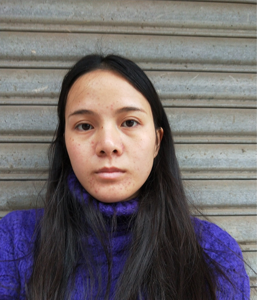 Lucy before using disposable facial cleansing towel – visible acne and uneven skin tone